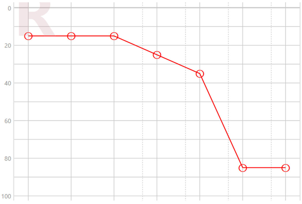 Figure 3 : Zone morte cochléaire probable