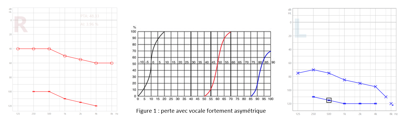 ZOOM Signia TriCROS sur l'appareillage de la perte auditive avec vocale fortement asymétrique figure 1