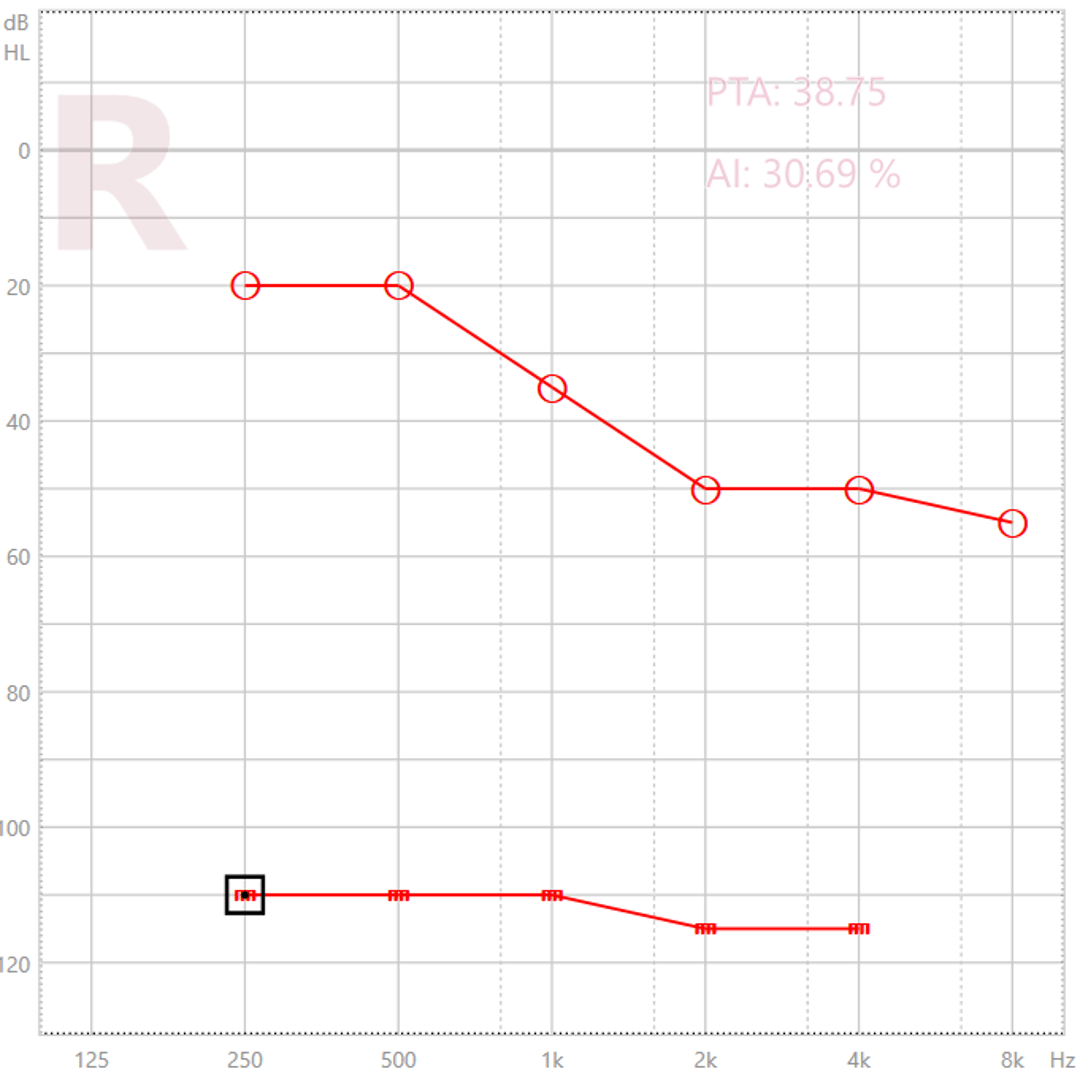 exemple d'audiogramme dans connexx