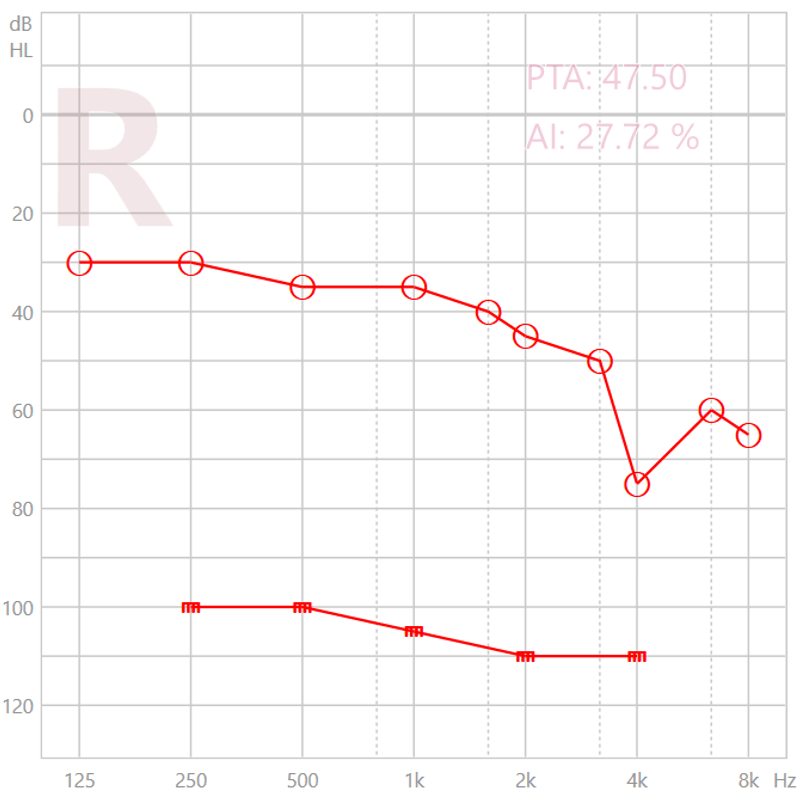 figure 4 Scotome à 4 kHz sur laudiogramme